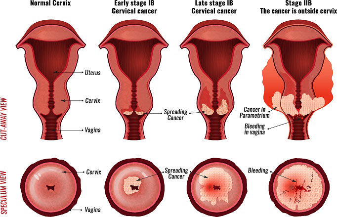 The four primary stages of cervical cancer development.