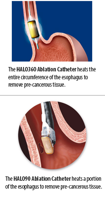 Halo endocopic ablation catheter
