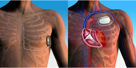 Device Implantation