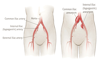 Comparison of healthy aorta and iliac aneurysm anatomy.