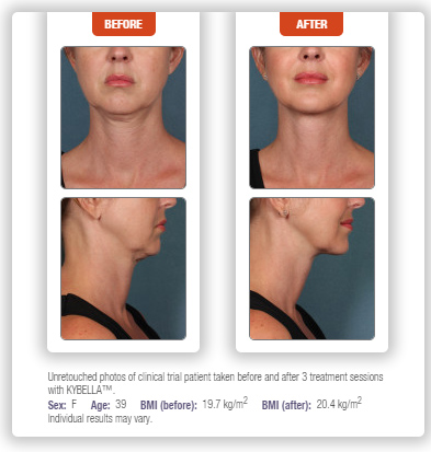 KYBELLA Treatments