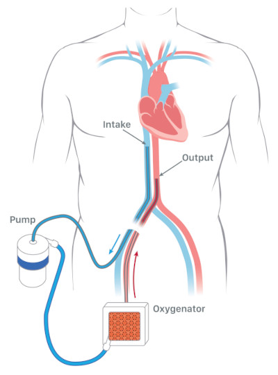 Illustration of how ECMO works in the body